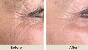 ADVATX TREATMENT before and after at setiba medical spa in westlake village ca
