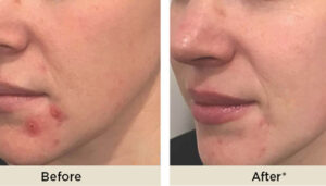another ADVATX TREATMENT before and after at setiba medical spa in westlake village ca