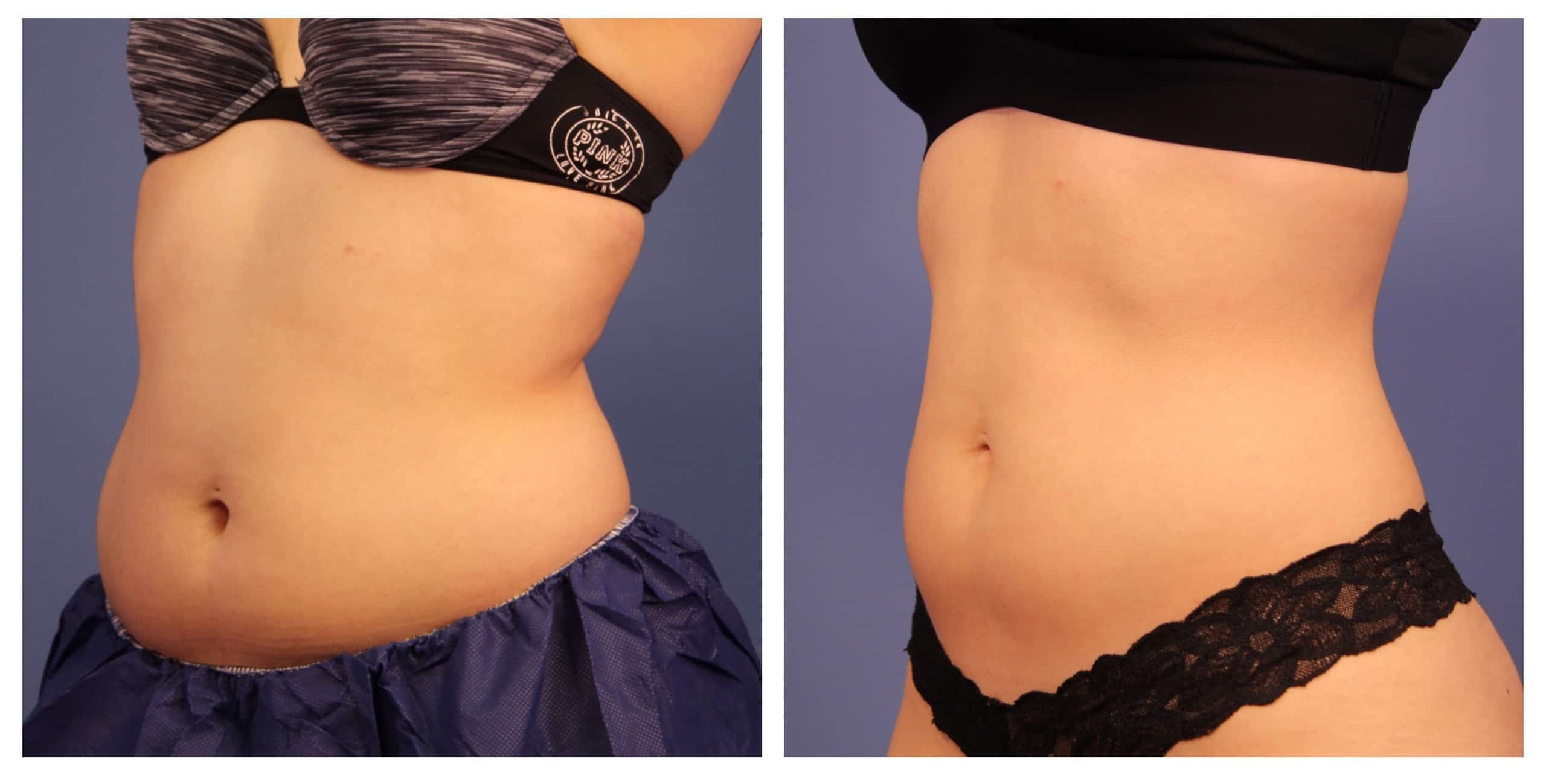 is Coolsculpting Permanent or Temporary?