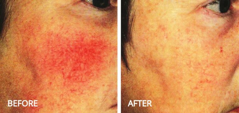 Undeniable Results With the CO2 Laser: Before and After