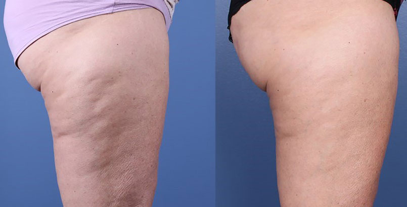 How to get rid of cellulite in 2021: Best cellulite treatment and