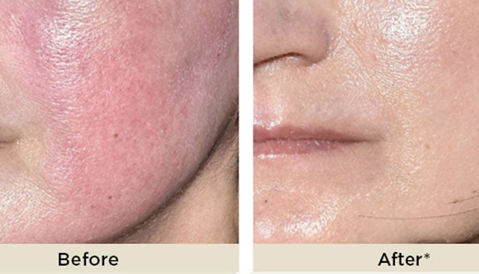 ADVATX TREATMENT before and after at setiba medical spa in westlake village ca