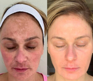 client Cosmelan peel before and after