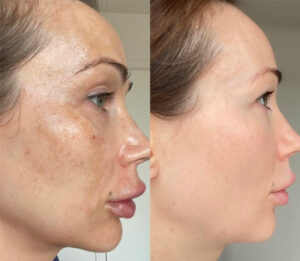 another client Cosmelan peel before and after