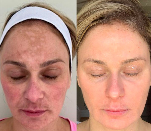 Cosmelan Facial Peel