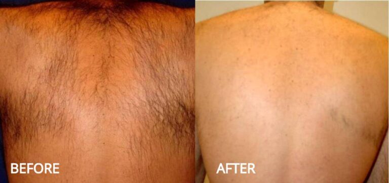 Laser Hair Removal Treatment in Setibamedicalspa Westlake Village CA